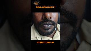 Vitiligo vitiligo lips vitiligo causes vitiligo treatment vitiligo hospital vitiligo skin [upl. by Elyk]