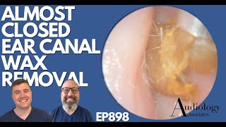 ALMOST CLOSED EAR CANAL WAX REMOVAL  EP898 [upl. by Neeham]