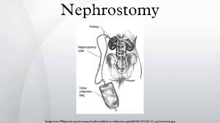 Nephrostomy [upl. by Otti]