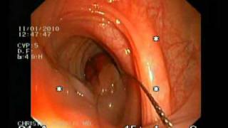 POLYPECTOMY OF A LARGE STALK POLYP CHRISTOS KARALIS MD WMV [upl. by Jasen288]