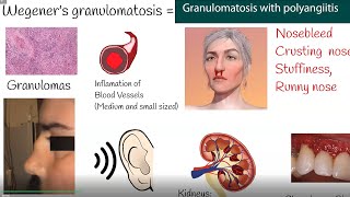 Wegeners granulomatosis  Granulomatosis with polyangiitis  Symptoms and causes [upl. by Notac]