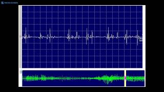 Kimura amp Kohara F61 A highamplitude shortduration spiky MUP seen in IBM [upl. by Jeromy302]