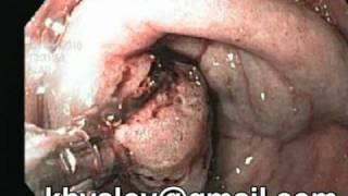 Adenomatous polyp of pyloric Endoscopic diagnosis [upl. by Tremml]