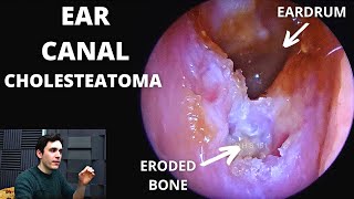 Ear Canal Cholesteatoma Bone Eroding [upl. by Cirdla7]