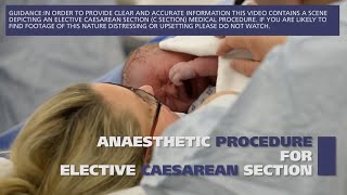 Anaesthetic procedure for elective caesarean section C section [upl. by Oitaroh630]