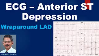 ECG – Anterior ST Depression Includes a discussion on wraparound LAD [upl. by Sacksen]