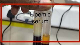 lipemic serum meaning in hindi [upl. by Kruse578]