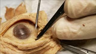 Exenterated Eyeball 1 – Conjunctival Dissection with Clinical Aspects – Sanjoy Sanyal [upl. by Vince]