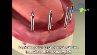 Implants Mini Implant Overdenture Procedure [upl. by Ignacia]