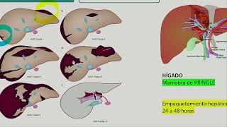 III Trauma Hepatico Esplenico y Pancreatico [upl. by Arad289]