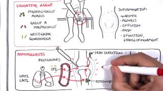 Septic Arthritis  Overview causes pathophysiology treatment [upl. by Icyak]