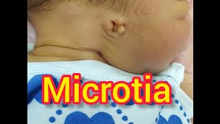 Microtiamedicalshorts medicalvideos medicalstudent congenitaldefect [upl. by Dnalel898]