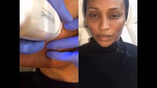 EndyMed RF Micro Needling with RHOAs Cynthia Bailey at Ederra Bella [upl. by Althee]