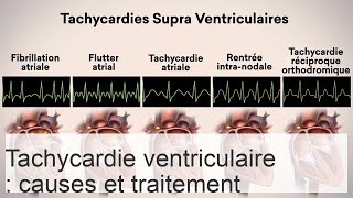 Tachycardie ventriculaire  prévalence causes manifestations et correction [upl. by Khosrow]