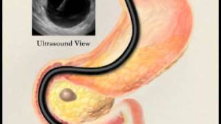 Endoscopic Ultrasound with Fine Needle Aspiration Biopsy [upl. by Ailahtan746]