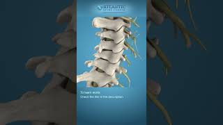 What is Cervical Disc Herniation Shorts [upl. by Atteloj]