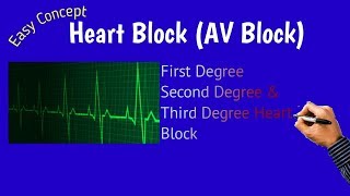 Heart Block  AV block Atrioventricular Block [upl. by Desdamonna]