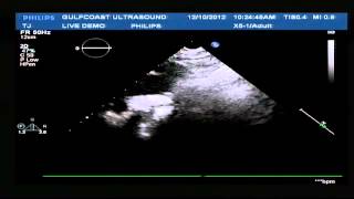 Hot Tips  Finding the Aortic Arch with Ultrasound [upl. by Ritchie]