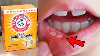 How to Use Baking Soda for Canker Sores [upl. by Jorrie]