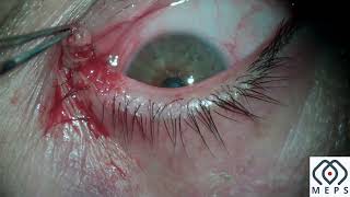 Eyelid Nevus Excision with RF [upl. by Broder]