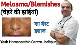 चेहरे पर झाँईयाँ । धब्बे । melasma chloasma blemishes hyperpigmentation [upl. by Aissac]