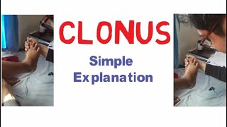 Clonus Mechanism Correct Way of Examination and Demonstration  Clinical Sign [upl. by Eelirak]