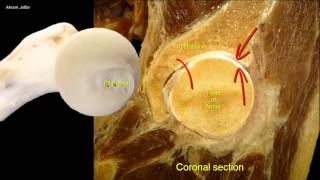 Femoral neck fracture  applied anatomy [upl. by Saks511]