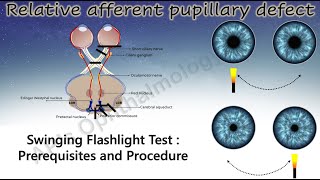 Pupil 3  How to Perform the Swinging Flashlight Test [upl. by Zetnas481]