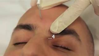 Sebaceous Hyperplasia Treatment using Electrodessication [upl. by Cila]