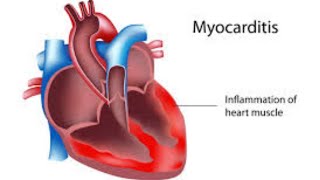 شرح Myocarditis 💓💯💫 [upl. by Eicnan93]