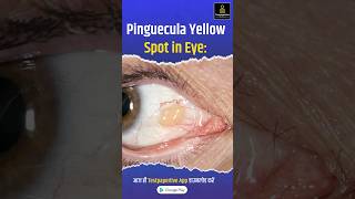 Pinguecula Yellow Spot in Eye Pinguecula eye testpaperlive [upl. by Anomahs239]