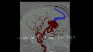 AVM  arteriovenous malformations in the brain amp cerebral hemorrhage animation by Cal Shipley MD [upl. by Santoro]