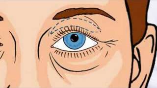 Blepharoplasty by McDiarmidHall Clinic [upl. by Lennon]