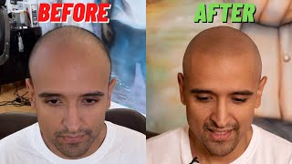 INCREDIBLE Scalp Micropigmentation Transformation [upl. by Dilisio]