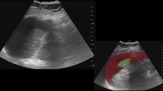 Positive Fast Positive RUSH ultrasound Syncope abdominal pain Bleeding abdominal mass 62021 [upl. by Ecniuq]