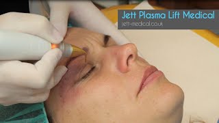 Blepharopolasty with the Jett Medical Plasma device [upl. by Dorisa]