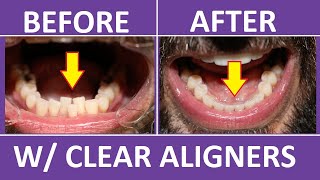 Invisalign Braces Before and After Overbite Crowding Teeth Cost Pain Tips 3M Clear Aligners [upl. by Namialus]