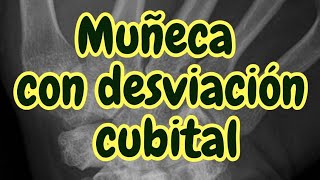 Muñeca con desviación cubital comparación de técnicas radiográficas [upl. by Uah]