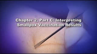 Chapter 2 Part C Interpreting Smallpox Vaccination Results [upl. by Dnumde]