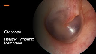 Tympanic Membrane Otosopy [upl. by Ayouqat]