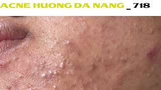 Acne Treatment Huong Da Nang 718  Remove Blackheads [upl. by Eentruok]