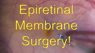 Epiretinal membrane surgery Vitrectomy with ERM Macular Pucker peeling  Dr Simon Chen [upl. by Ruford]