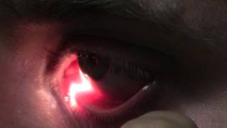 Ophthalmic Skills Video  Basics in Slit Lamp Examination [upl. by Bik536]