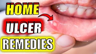 19 Fast amp Effective MOUTH ULCER Home Remedies CANKER SORES [upl. by Gigi]