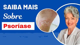 TUDO Sobre PSORÍASE PLANTAR [upl. by Enyedy]