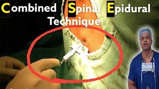 Combined Spinal Epidural Anaesthesia technique  Procedural Video from Start to End  anesthesia [upl. by Nimrac805]