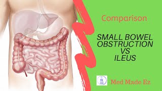 SBO vs Ileus  What is the difference [upl. by Enilkcaj99]