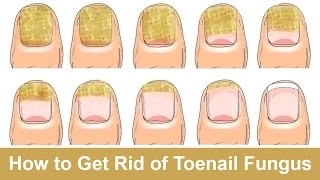 How to Get Rid of Toenail Fungus Fast and Naturally [upl. by Nnyla]