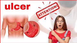 Ulcer ❔❎🙀 How to treat ulcer 🤯 Simple treatment for Ulcer 🤔💊❎ in English ❓ [upl. by Adnavoj]