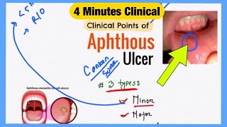 Aphthous Ulcer Explained Like Water  Symptoms Pathophysiology Treatment  Bengali Medicine Lecture [upl. by Leohcin]